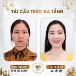 Phương pháp tái cấu trúc đa tầng