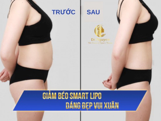 Giảm béo công nghệ cao Smart Lipo tại thẩm mỹ viện Dr. Nguyên